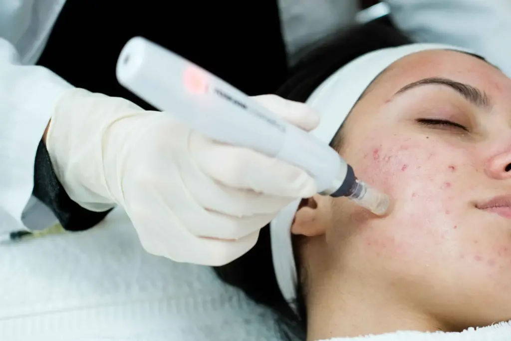Microneedling with PRP